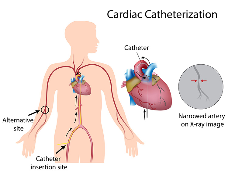Catheter