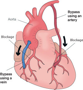 Heart bypass